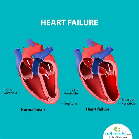 severe left ventricular dysfunction treatment